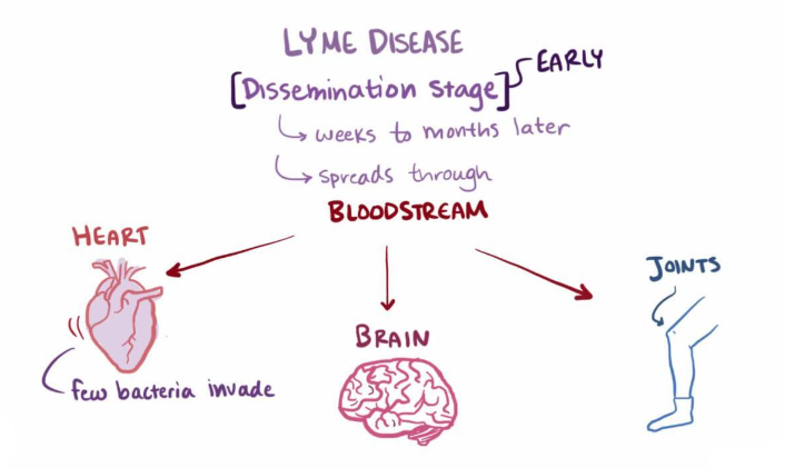 Stages of Lyme Disease from a tick bite.