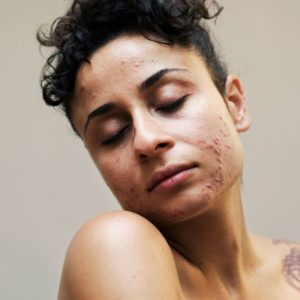 Gut skin axis acne skin leaky gut inflammation