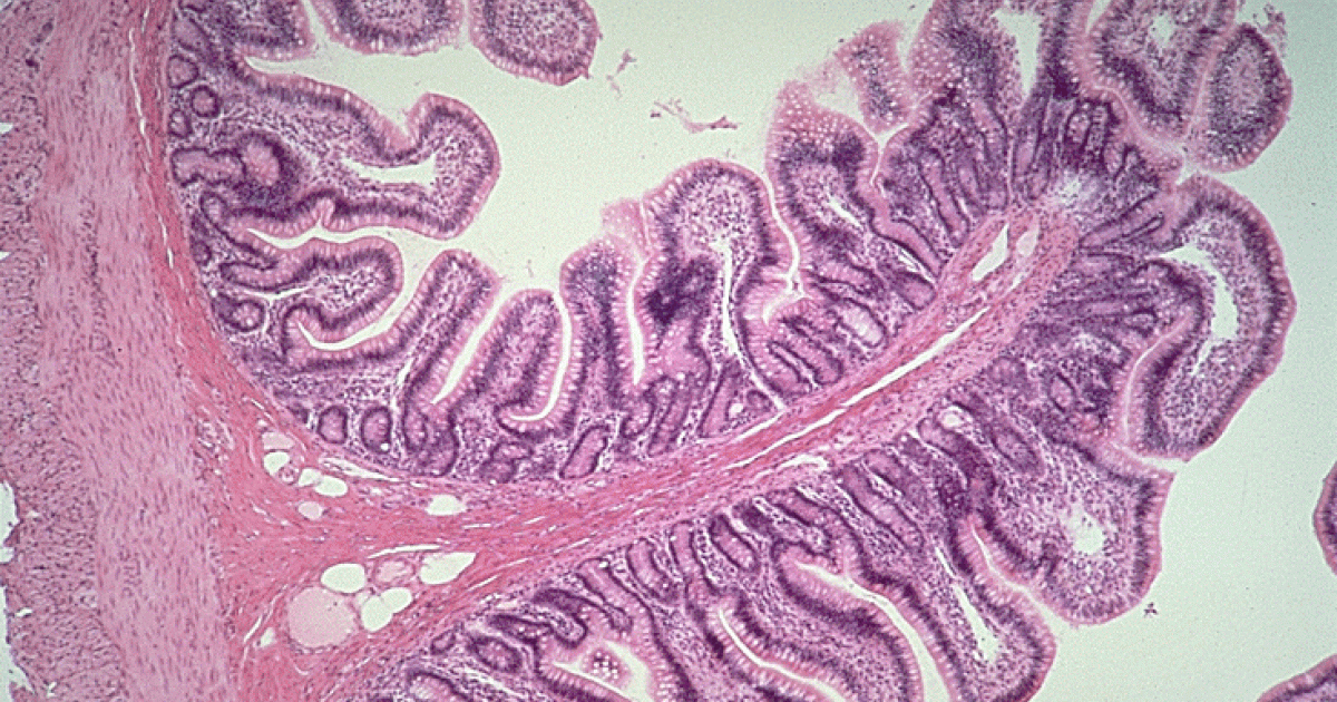 bacterial overgrowth in stomach